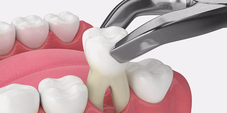 দাঁত তোলা চিকিৎসা